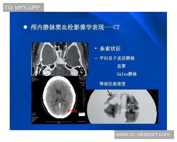 文班谈血栓伤病的医学分析与心理状态的积极应对 文班谈血栓伤病的医学分析与心理状态的积极应对